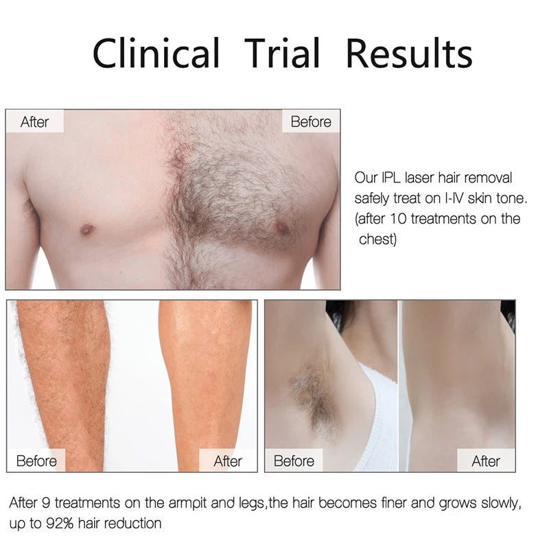 IPL Laser Hair Removal Device